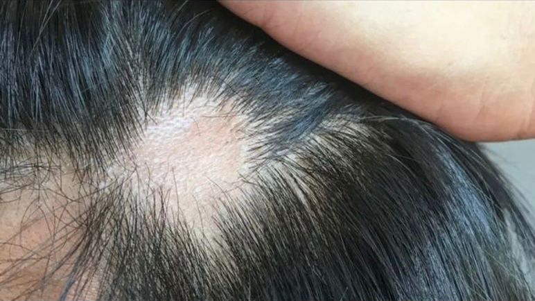 Queda acentuada de cabelos preocupa pacientes com covid-19